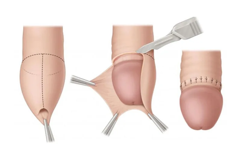 Cirurgia de Postectomia (Fimose) - Dra. Juliana Castro
